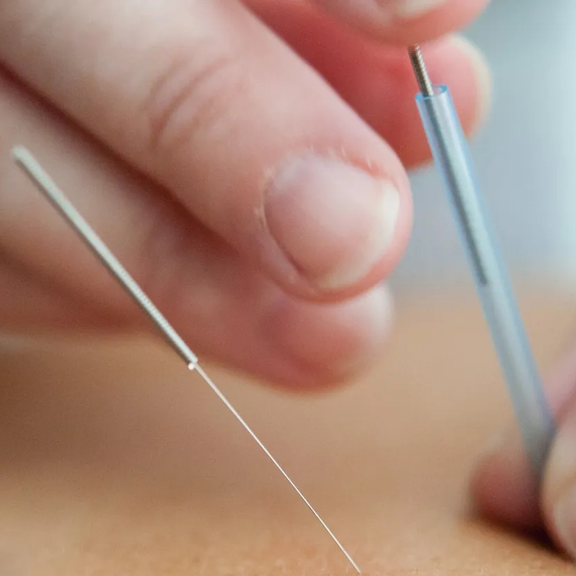 Dry Needling Treatment St Albert